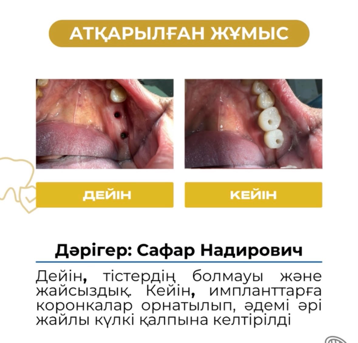 Работа до и после: импланты и коронки