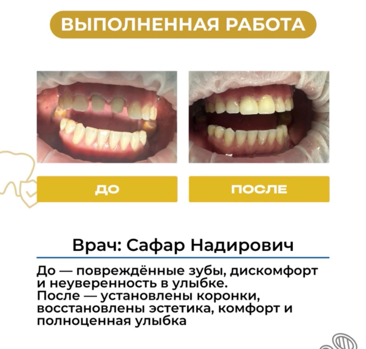 Работа до и после: установка коронок
