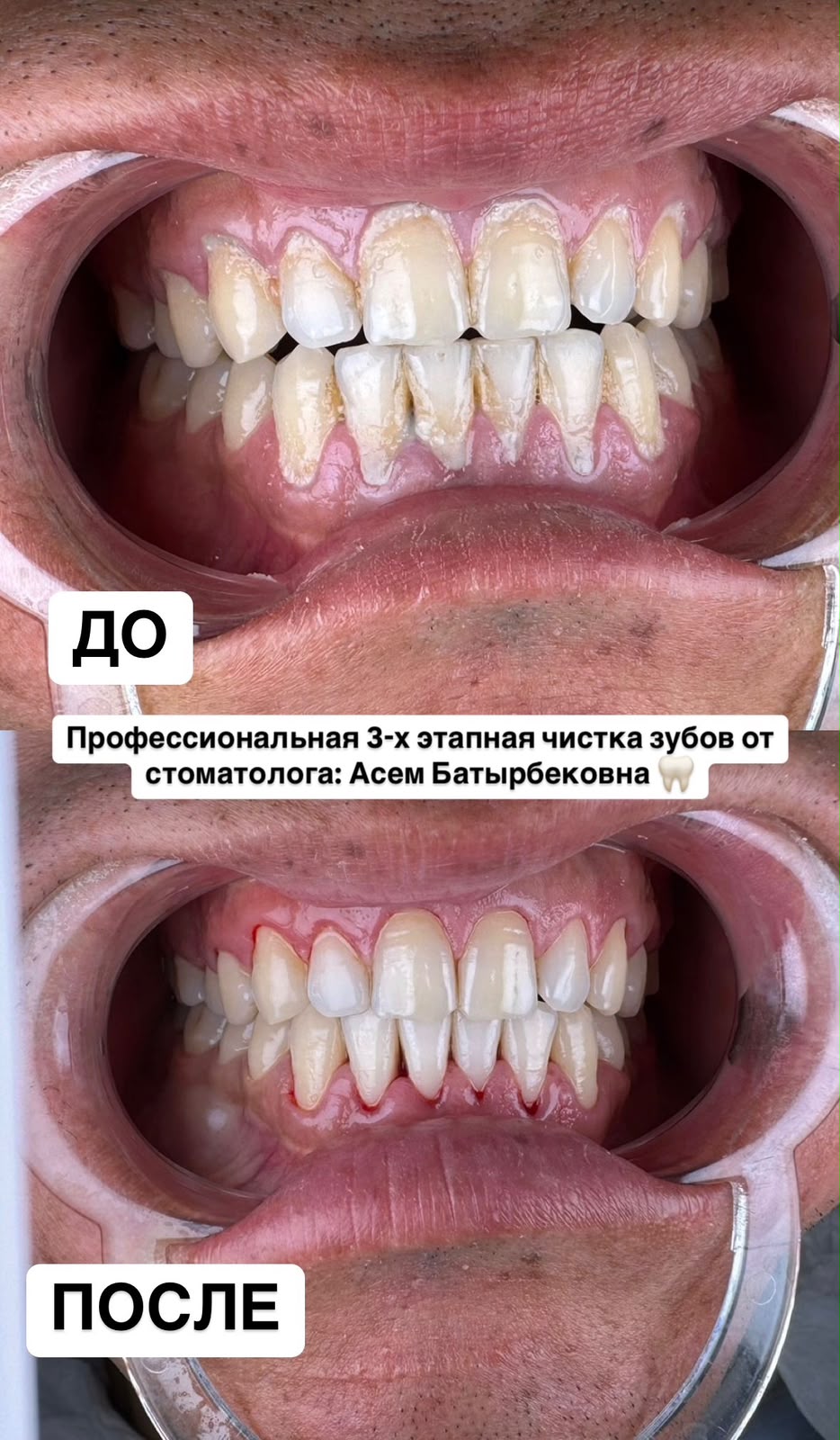 Профессиональная чистка зубов до и после